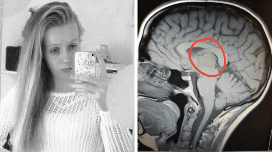 Christy Kelsey, 25, was diagnosed with a rare pineal cystic brain tumour after being told she just had migraines for ten years