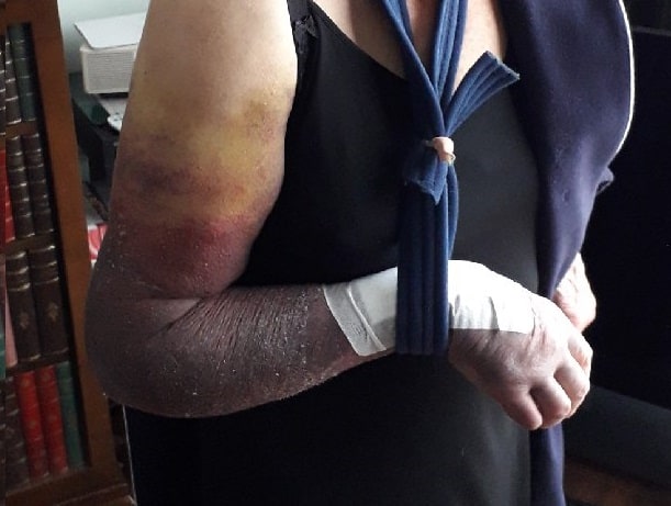 A picture of the 87-year-old's injuries after the horrific incident (Image: Met Police)