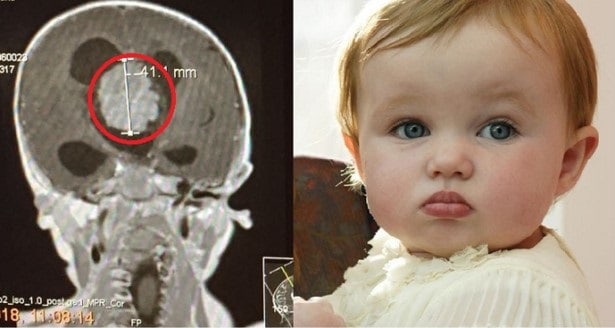 Octavia Begbey, who was saved by pioneering keyhole surgery on her brain at 14-months-old.